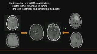 Imaging Diagnosis of CNS Tumors in Context of the New 2021 WHO Classification