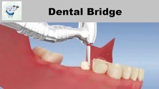 Dental Bridge Animation 3D