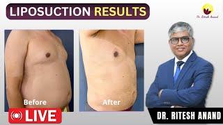 Liposuction Results - Before and After | Male Tummy Liposuction Live Procedure | Dr Ritesh Anand