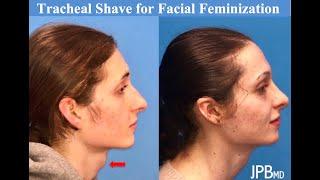 Tracheal Shave Neck Feminizatio