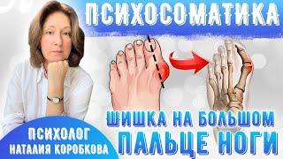 Шишка на большом пальце ноги Психосоматика