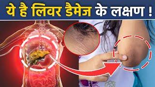 Liver Damage का Skin Symptoms, Acanthosis Nigricans Kya Hota Hai | Boldsky