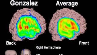 PET Scan Video used in Trial Win $1,600,000