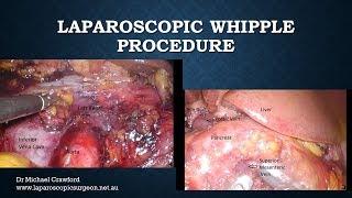 Laparoscopic Whipple Procedure