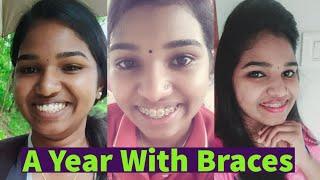 A Year With Braces | Braces Time Lapse | My Braces Journey