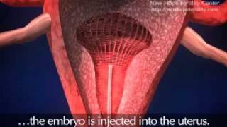 Embryo Transfer