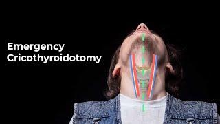 Performing an Emergent Cricothyroidotomy - MEDZCOOL