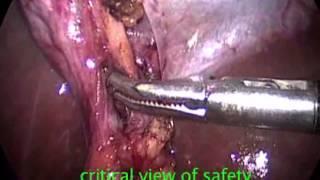 Laparoscopic Cholecystectomy / Dr Anil Sharma