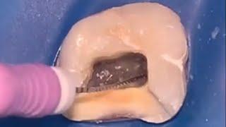 Maxillary Molar Access Opening, Pulp Stone Removal (with subtitles )