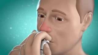 Nasenspray – worauf kommt es an?