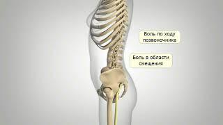 Спондилолистез: причины и симптомы