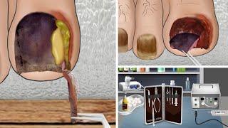 ASMR Ingrown Toenail removal treatment animation relax | 리얼한 내성 발톱 케어 애니메이션