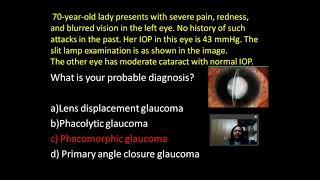 Glaucoma, Clinical Vignette:  Dr  Anuradha Dhawan