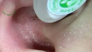 Removing big Blackhead in Ear Fantastic