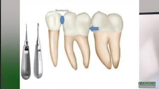 How to make molar extractions easier