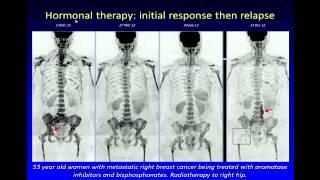 Third Annual TMII Symposium--    Anwar Padhani MD