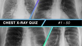 Chest X-ray Quiz #1 - 50