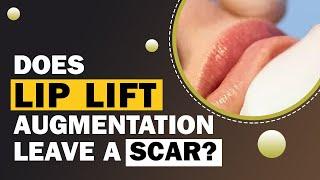 Does Lip Lift Augmentation Leave a Scar? Lip Augmentation in Delhi | Dr. PK Talwar