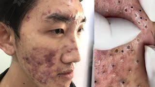 Big blackheads extraction blackheads,  removal acne – Lan spa