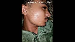 My Minoxidil 5% Journey: Shocking Before and After Transformation Revealed #minoxidil5