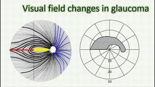 Visual field changes in glaucoma