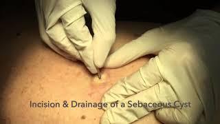 Incision & Drainage of a Sebaceous Cyst