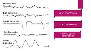 CTG INTERPRETATION