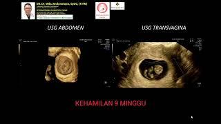 Perbedaan USG abdomen dan transvagina kehamilan 9 minggu