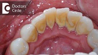 What can be the hard particle breaking away from tooth surface?-Dr. Jayaprakash Ittigi