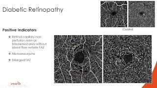 Optovue Solix OCT/OCT-A for Diabetes Evaluation with Dr. Julie Rodman