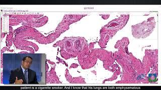 Pathology Insights: Atypical Epithelial Cells with Sanjay Mukhopadhyay, MD