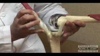 What is Knee Replacement Surgery - Finger Lakes Bone and Joint Center,