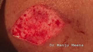 How to Harvest Dermis Fat Graft by Dr Manju Meena