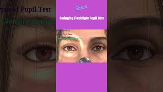 Pupil Examination | RAPD | Pupillary Light Reflex | Marcus Gunn Pupil | Swinging flashlight Test