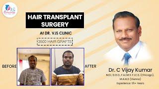 Hair Transplant Surgery of 3500 Hair Graft - Dr VJS Clinic