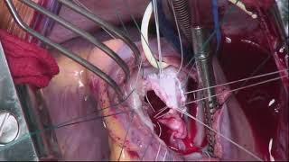 Tricuspid Valve Reconstruction for Infective Endocarditis: Operative Highlights (Graphic)