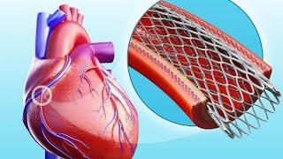 Stent implantation/ दिल के दौरे में कैसे बचाते है