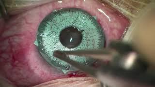 Artificial Colored Iris Explantation - Dr Sami A. Saad narrated by Dr A. Aziria