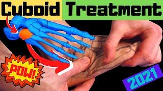 Cuboid Syndrome Self Treatment [Cuboid Bone: Outside of Foot Pain]