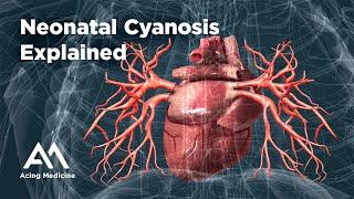 Neonatal Cyanosis Explained: PDA-Dependent Congenital Heart Disease - Acing Medicine