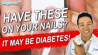 5 Diabetic Nail Problems & Top Signs of Diabetes on The Nails!