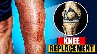 Total Knee Replacement Surgery 3D Animation | 3D Animation of a Knee Replacement | Joint Replacement