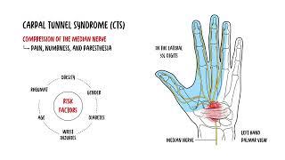 Carpal Tunnel Syndrome and Carpal Tunnel Anatomy
