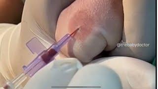 IV cannula insertion procedure in a newborn|| the baby doctor || pediatrics #newborn #ivcannula