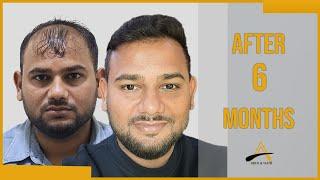 Great transformation | Hair Restoration | 6 months @alloroots