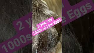 Toddler with 1000s of Lice Eggs l Extreme Lice Infestation l Lice Removal Service