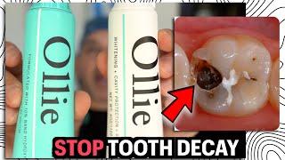 Best Toothpaste to STOP Tooth Decay | Fluoride vs Hydroxyapatite