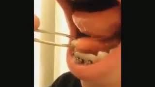 Sialolithiasis—Salivary duct stone removal