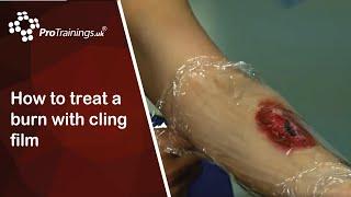 How to treat a burn with cling film