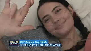 Woman with water allergy describes living with rare condition